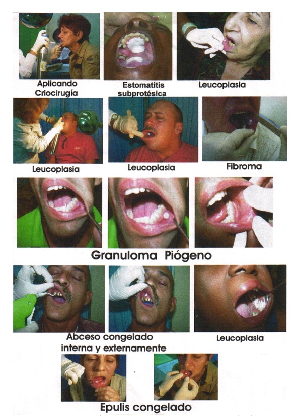 Diversos casos clínicos tratados con Criocirugía