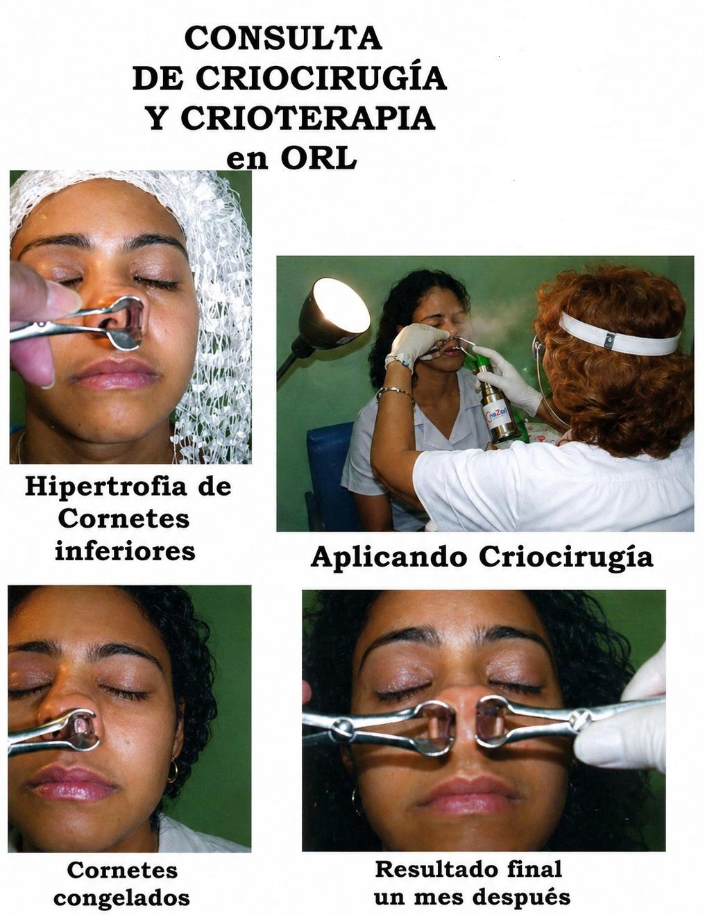 Aplicación de Crioterapia para rehabilitación