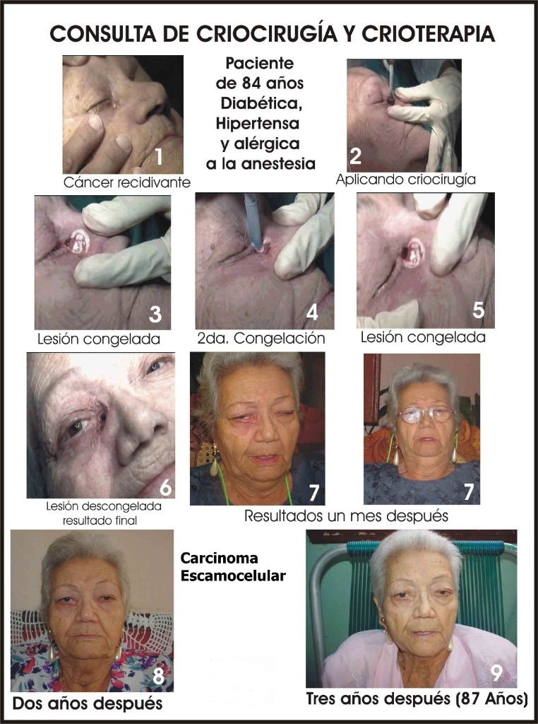 Caso de Carcinoma en Criocirugía