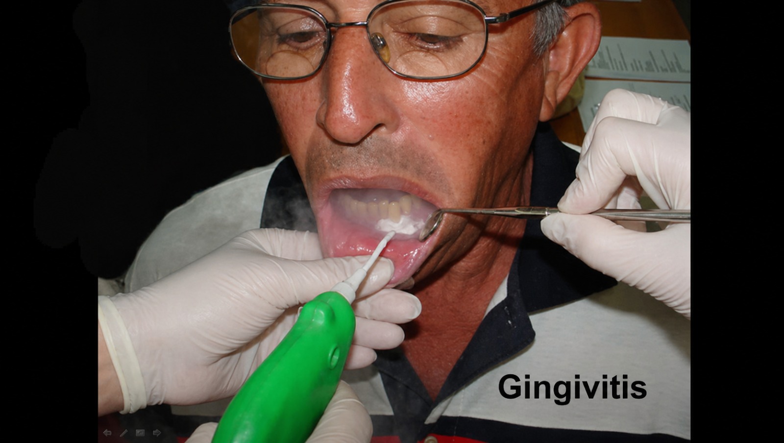 Tratamiento de Gingivitis con Criocirugía