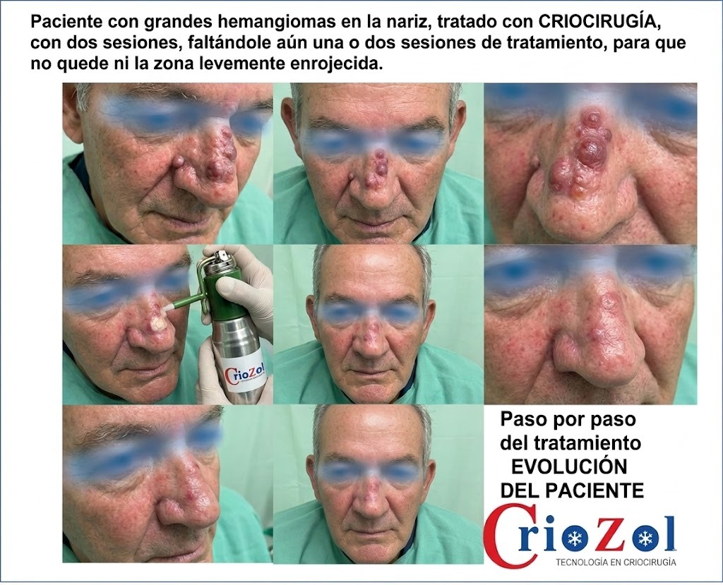 Reducción de Hemangiomas con Criocirugía