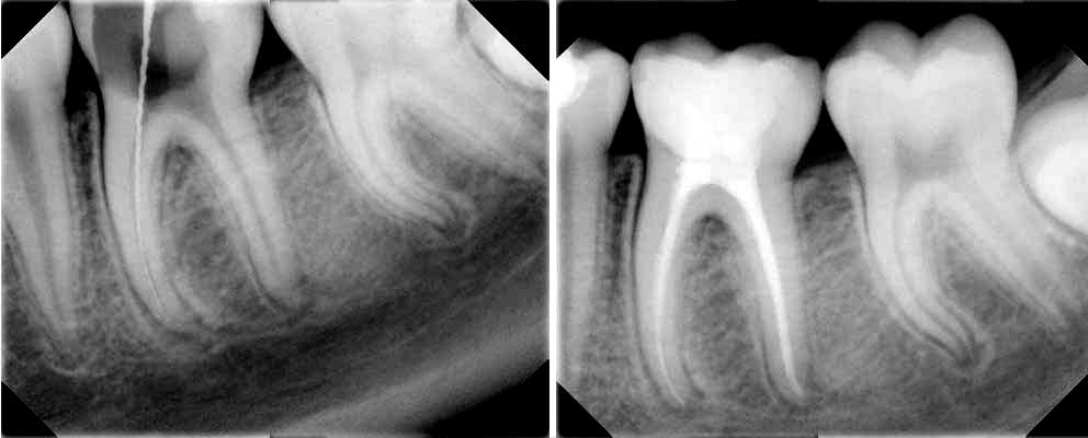 Endodoncia